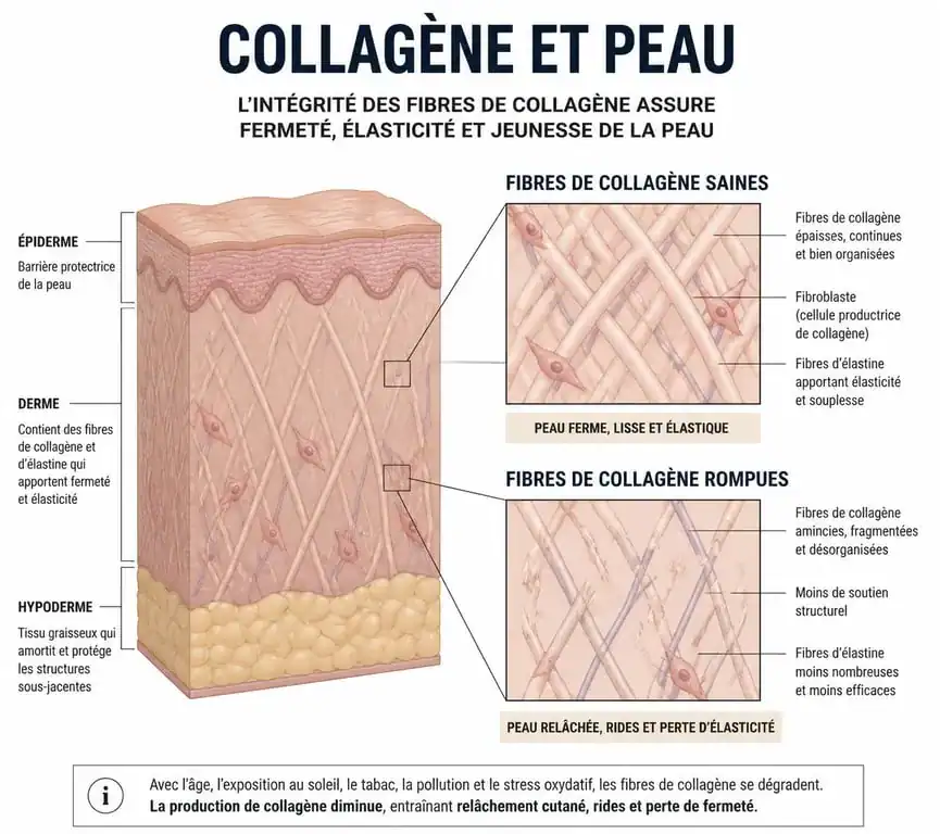 Schéma explicatif du mécanisme de formation des vergetures et de la rupture des fibres de collagène dans le derme